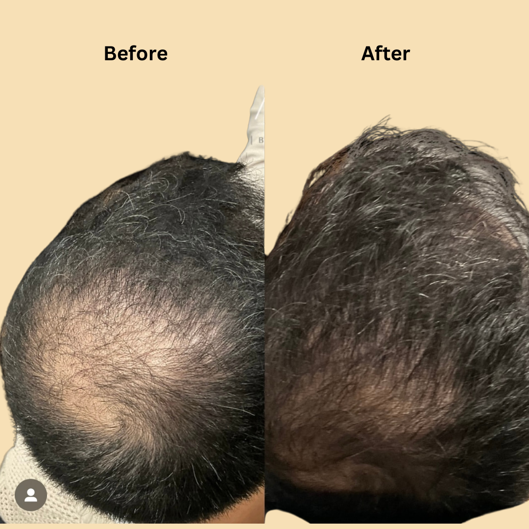 Hair Restoration